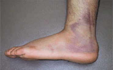 画像：受傷（捻挫）後の内出血の一例